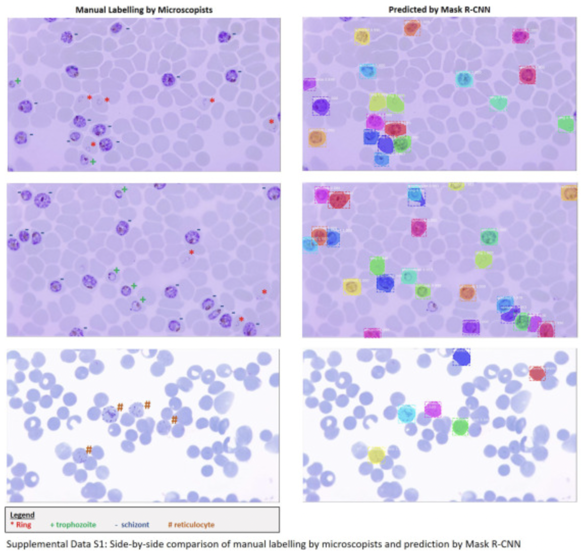 A deep learning approach to the screening of malaria infection: Automated and rapid cell counting, object detection and instance segmentation using Mask R-CNN